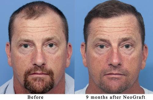NeoGraft Hair Restoration Before & After Gallery - Patient 58490595 - Image 1