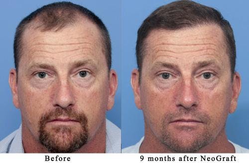 NeoGraft