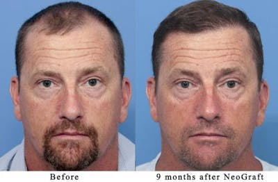 NeoGraft Hair Restoration Before & After Gallery - Patient 58490595 - Image 1