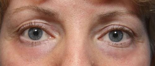 Laser Treatments Before & After Gallery - Patient 58490589 - Image 6