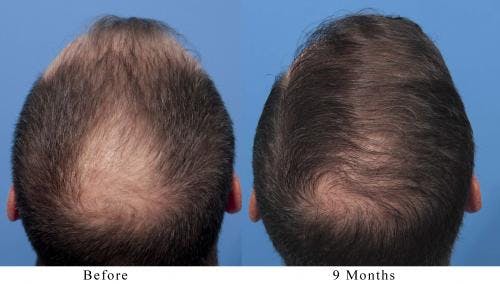 NeoGraft Hair Restoration Before & After Gallery - Patient 58490595 - Image 2