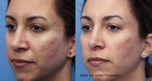 Infini Before & After Gallery - Patient 58490592 - Image 1