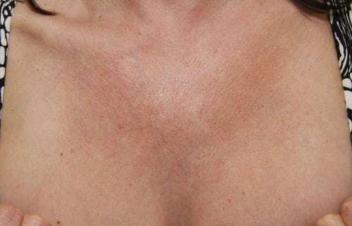 Laser Treatments Before & After Gallery - Patient 58490593 - Image 1