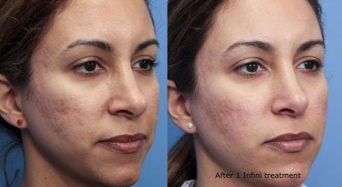Infini Before & After Gallery - Patient 58490592 - Image 2