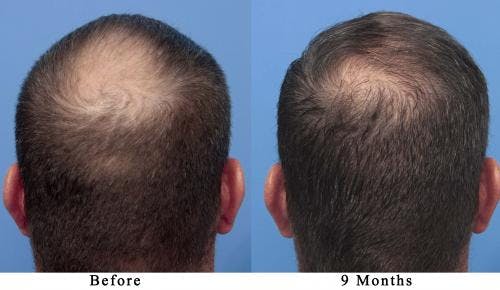 NeoGraft Hair Restoration Before & After Gallery - Patient 58490595 - Image 3