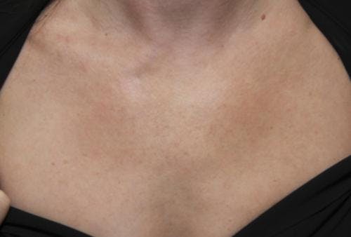 Laser Treatments Before & After Gallery - Patient 58490593 - Image 2