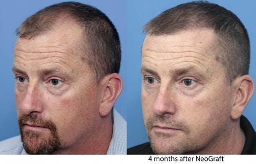 NeoGraft Hair Restoration Before & After Gallery - Patient 58490595 - Image 4
