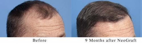 NeoGraft Hair Restoration Before & After Gallery - Patient 58490595 - Image 5