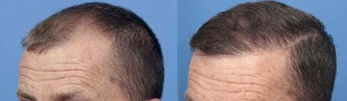 NeoGraft Hair Restoration Before & After Gallery - Patient 58490595 - Image 6