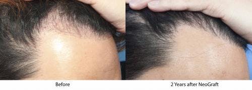 NeoGraft Hair Restoration Before & After Gallery - Patient 58490596 - Image 1