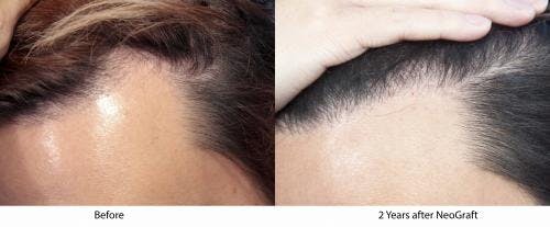 NeoGraft Hair Restoration Before & After Gallery - Patient 58490596 - Image 2