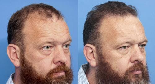 NeoGraft Hair Restoration Before & After Gallery - Patient 58490599 - Image 1