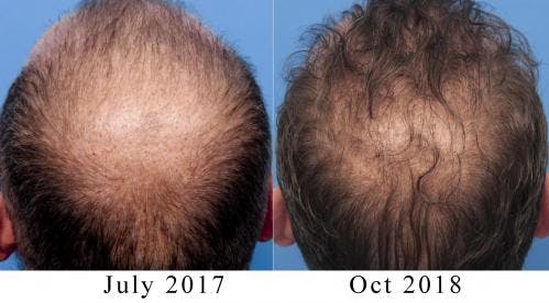 NeoGraft Hair Restoration Before & After Gallery - Patient 58490599 - Image 2