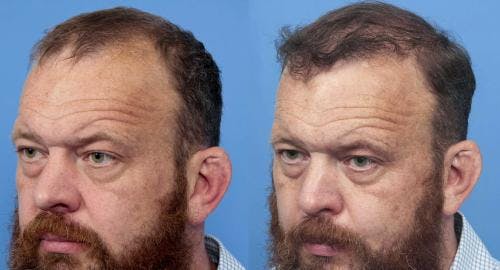 NeoGraft Hair Restoration Before & After Gallery - Patient 58490599 - Image 3