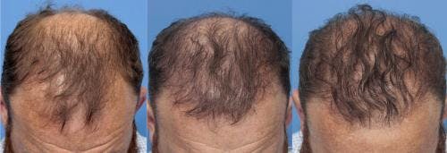 NeoGraft Hair Restoration Before & After Gallery - Patient 58490599 - Image 5