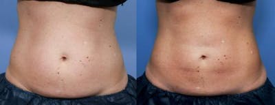 Body Before & After Gallery - Patient 58490597 - Image 1