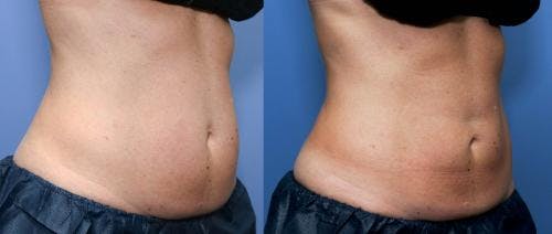 Body Before & After Gallery - Patient 58490597 - Image 2