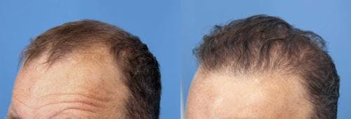 NeoGraft Hair Restoration Before & After Gallery - Patient 58490599 - Image 7