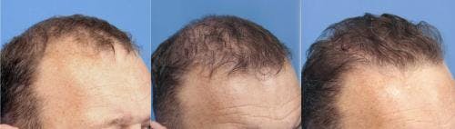 NeoGraft Hair Restoration Before & After Gallery - Patient 58490599 - Image 8