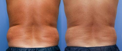 Body Before & After Gallery - Patient 58490600 - Image 2