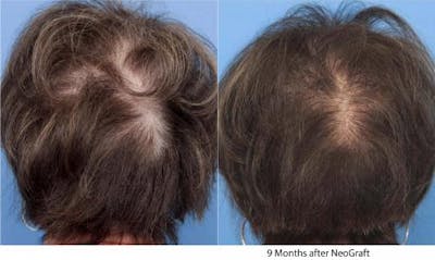 NeoGraft Hair Restoration Before & After Gallery - Patient 58490601 - Image 1