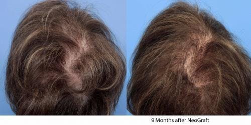 Female Hair Restoration Before & After Gallery - Patient 131385328 - Image 2
