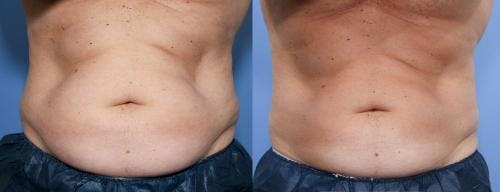 Body Before & After Gallery - Patient 58490602 - Image 1
