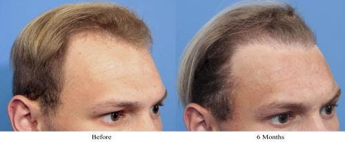 NeoGraft Hair Restoration Before & After Gallery - Patient 58490603 - Image 1