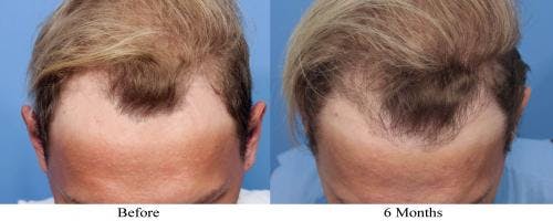 NeoGraft Hair Restoration Before & After Gallery - Patient 58490603 - Image 2