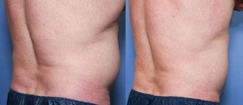 Body Before & After Gallery - Patient 58490604 - Image 1