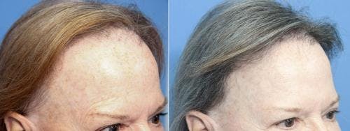 Female Hair Restoration Before & After Gallery - Patient 131385329 - Image 2