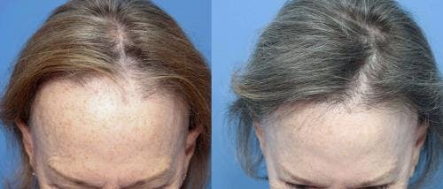 Female Hair Restoration Before & After Gallery - Patient 131385329 - Image 3