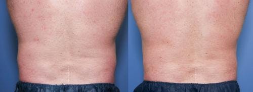 Body Before & After Gallery - Patient 58490604 - Image 4