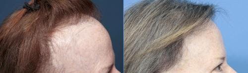 Female Hair Restoration Before & After Gallery - Patient 131385329 - Image 4
