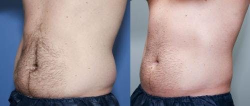 Body Before & After Gallery - Patient 58490605 - Image 2