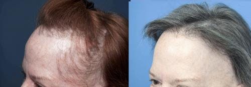 Female Hair Restoration Before & After Gallery - Patient 131385329 - Image 5
