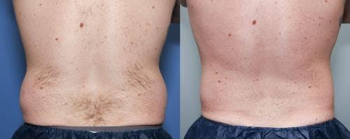Body Before & After Gallery - Patient 58490605 - Image 3