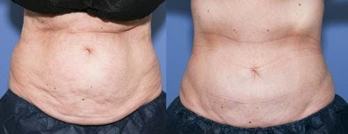 Body Before & After Gallery - Patient 58490607 - Image 1
