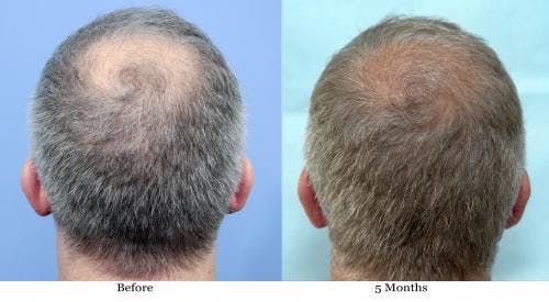 NeoGraft Hair Restoration Before & After Gallery - Patient 58490608 - Image 1
