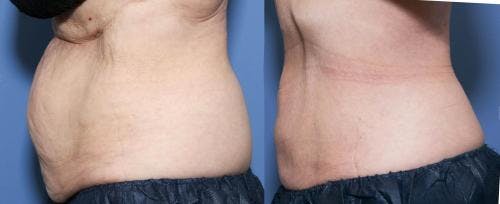 Body Before & After Gallery - Patient 58490607 - Image 2