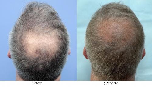 NeoGraft Hair Restoration Before & After Gallery - Patient 58490608 - Image 2