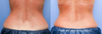 Body Before & After Gallery - Patient 58490609 - Image 1