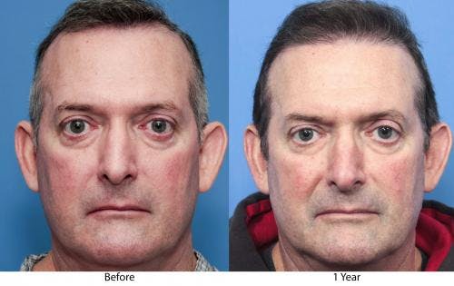 NeoGraft Hair Restoration Before & After Gallery - Patient 58490614 - Image 1