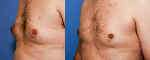 Body Before & After Gallery - Patient 58490610 - Image 1
