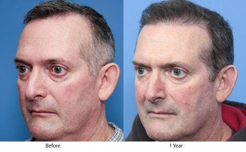 NeoGraft Hair Restoration Before & After Gallery - Patient 58490614 - Image 2