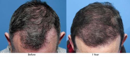 NeoGraft Hair Restoration Before & After Gallery - Patient 58490614 - Image 3