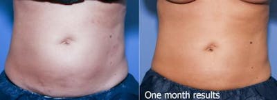 Body Before & After Gallery - Patient 58490611 - Image 1