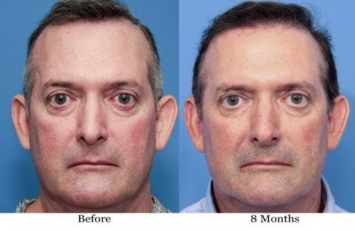 NeoGraft Hair Restoration Before & After Gallery - Patient 58490614 - Image 4