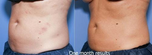 Body Before & After Gallery - Patient 58490611 - Image 2