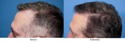 NeoGraft Hair Restoration Before & After Gallery - Patient 58490614 - Image 5